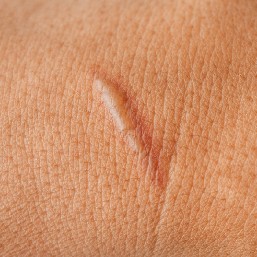 Lea Dermorepair Tatouage Therapeutique Avignon Accident